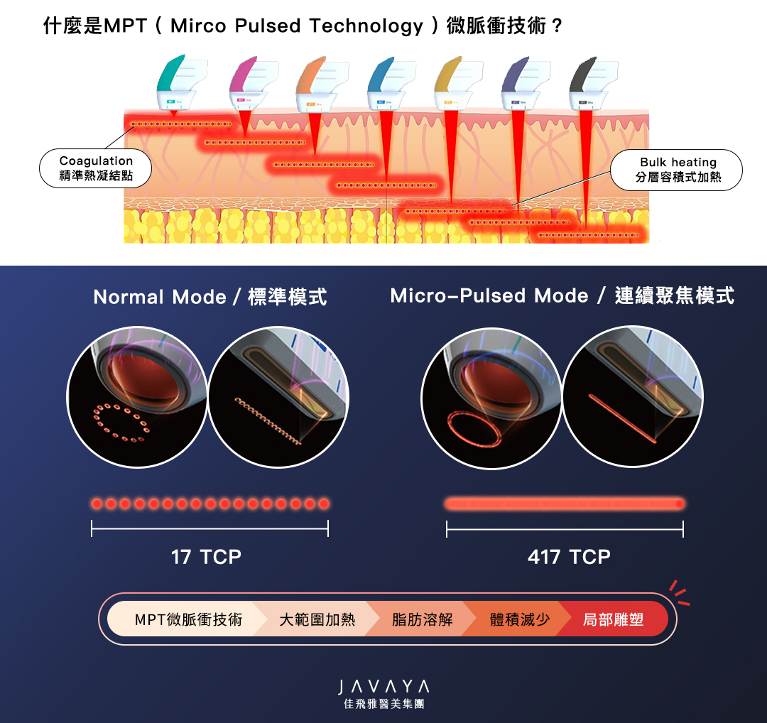 海芙音波媚必提MPT治療原理：什麼是MPT微脈衝技術？分為兩種模式切換：標準模式、連續聚焦模式